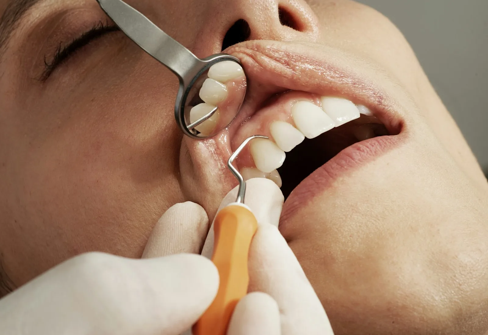 Teeth Whitening